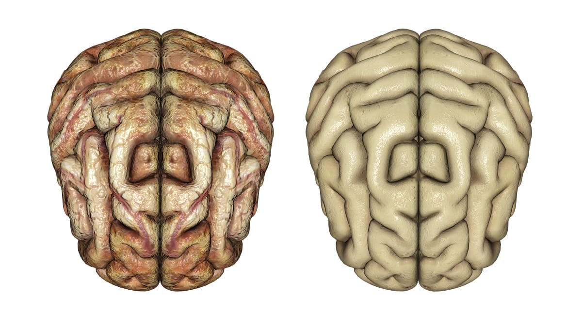 Pesquisadores identificam uma proteína que pode estar diretamente ligada ao desgaste cerebral em pessoas idosas (Foto: Banco de Imagens)
