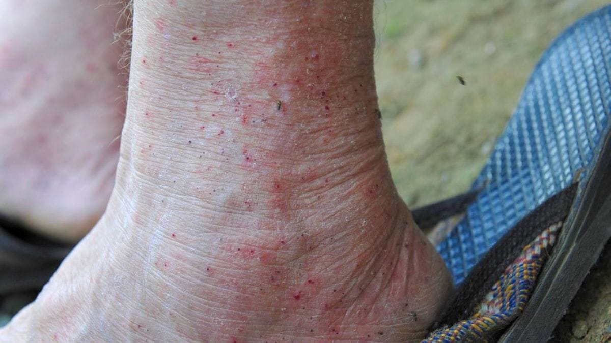 Picadas de borrachudos