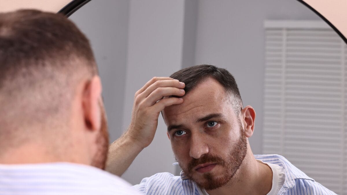 cebola alopecia areata