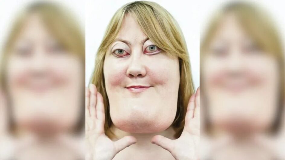 Victoria Wright, mulher com querubismo, sorri para a câmera