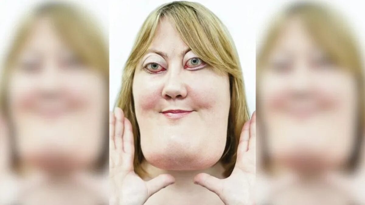 Victoria Wright, mulher com querubismo, sorri para a câmera
