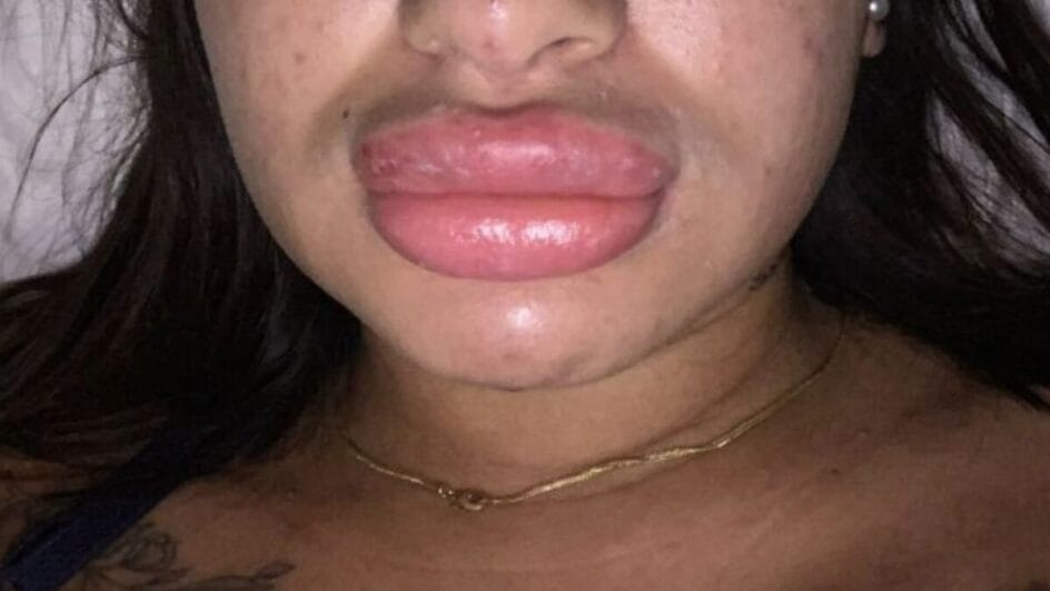 Vítima fez procedimento nos lábios e em questão de minutos sentiu o inchaço iniciar (Foto: PCSC, Divulgação)
