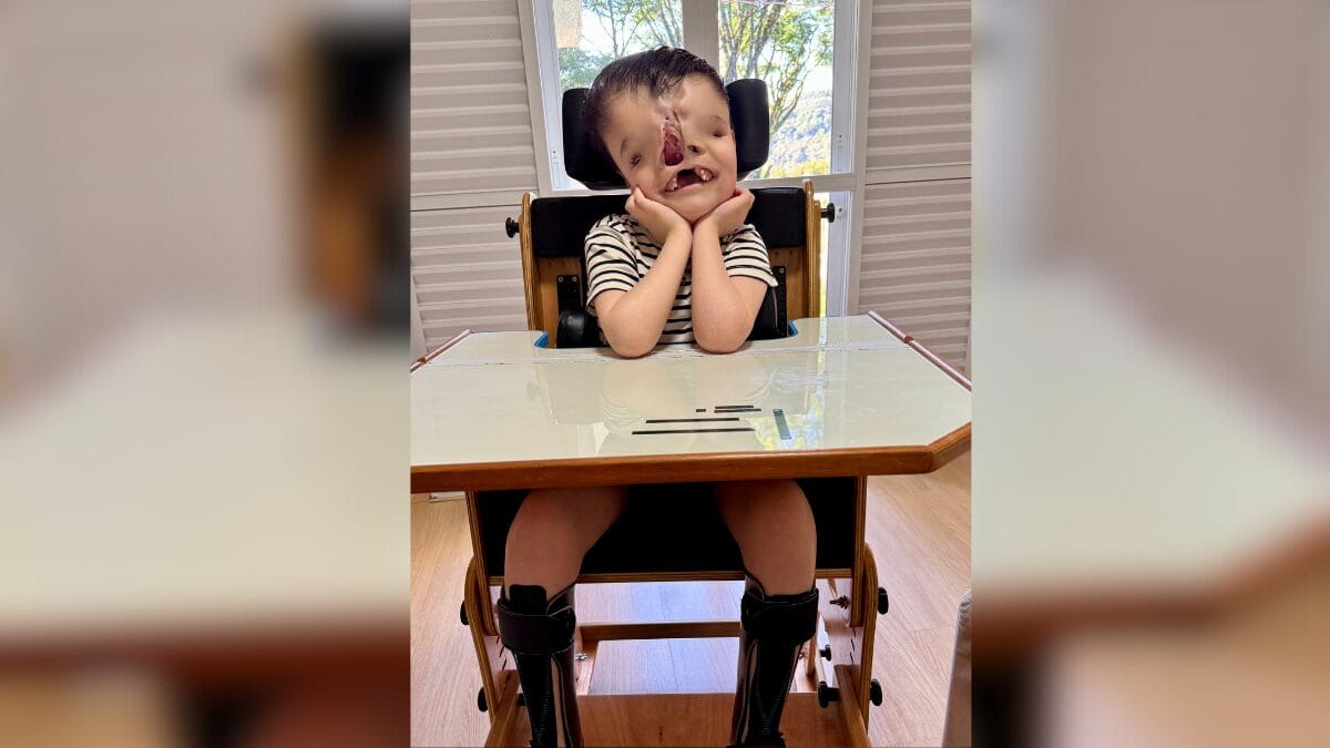 Criança com malformação craniofacial rara