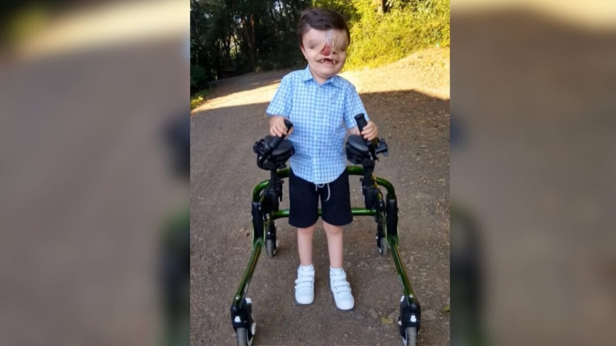 Criança com malformação craniofacial rara