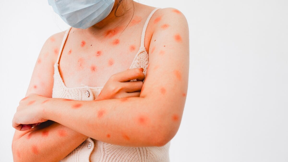 O que é Mpox, infecção viral transmitida por contato próximo com 81 casos no Brasil