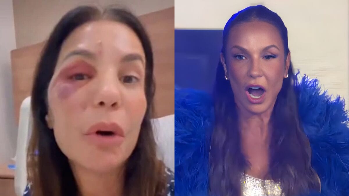 Ivete Sangalo reaparece no BBB 26 depois de acidente_ veja como está o rosto da cantora