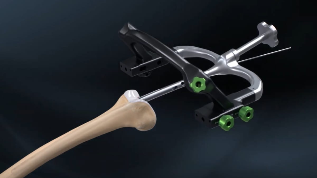 Nova tecnologia usada pela primeira vez no pa&iacute;s ajuda a preservar pr&oacute;tese e reduzir tempo de interna&ccedil;&atilde;o (Reprodu&ccedil;&atilde;o: YouTube)