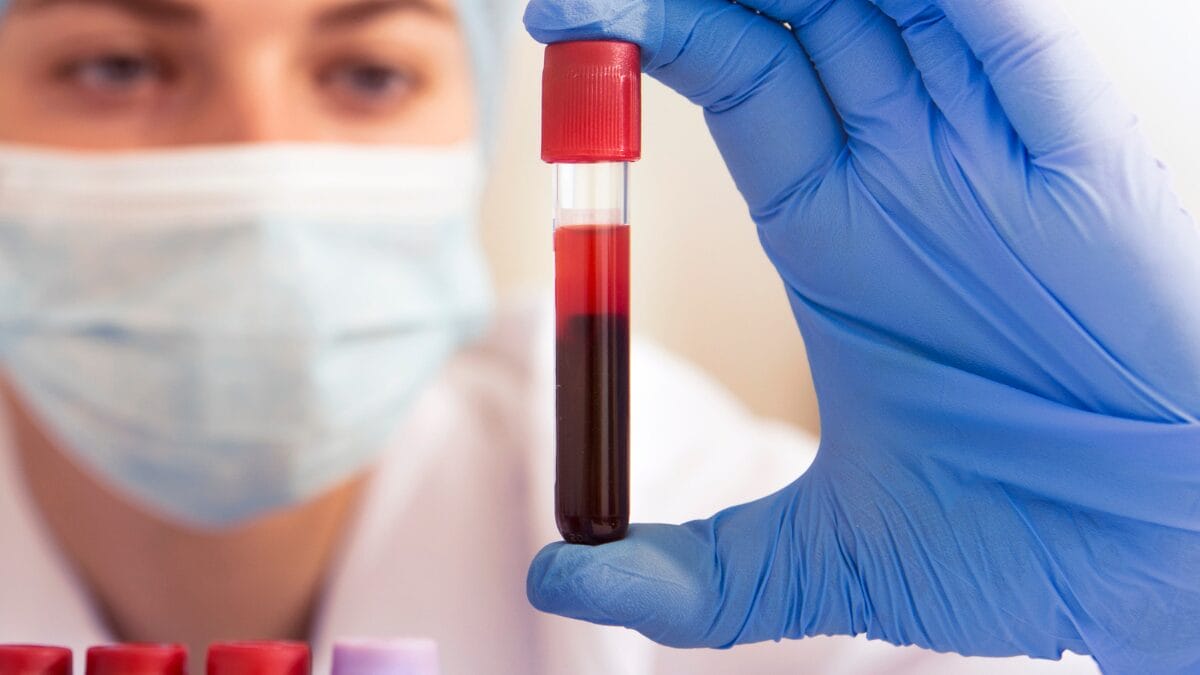 exame de sangue com inteligência artificial capaz de detectar fibrose no fígado em estágios iniciais (1)