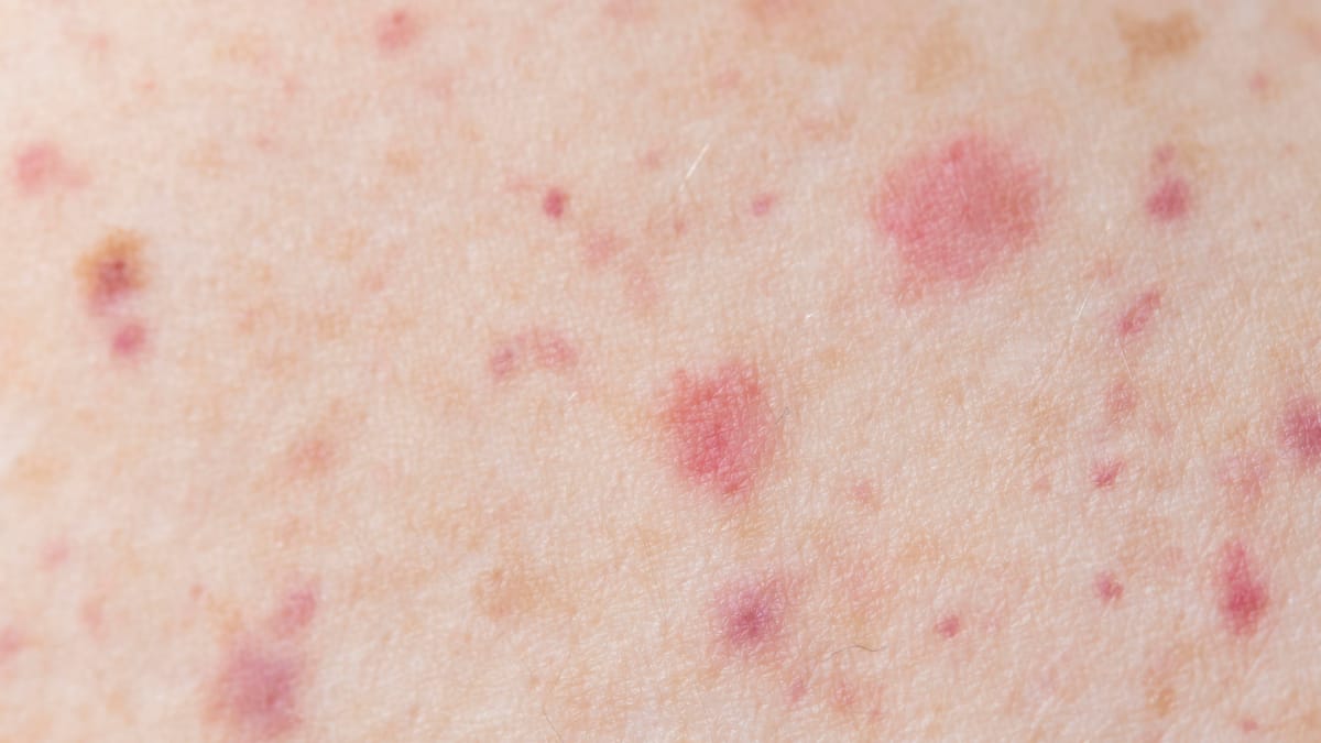 Pequenos impactos podem virar manchas vis&iacute;veis em momentos de estresse (Foto: Freepik)