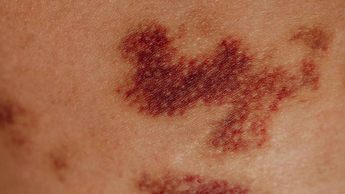 Nem todo roxo vem de pancada, o emocional tamb&eacute;m pode influenciar (Foto: Pexels)