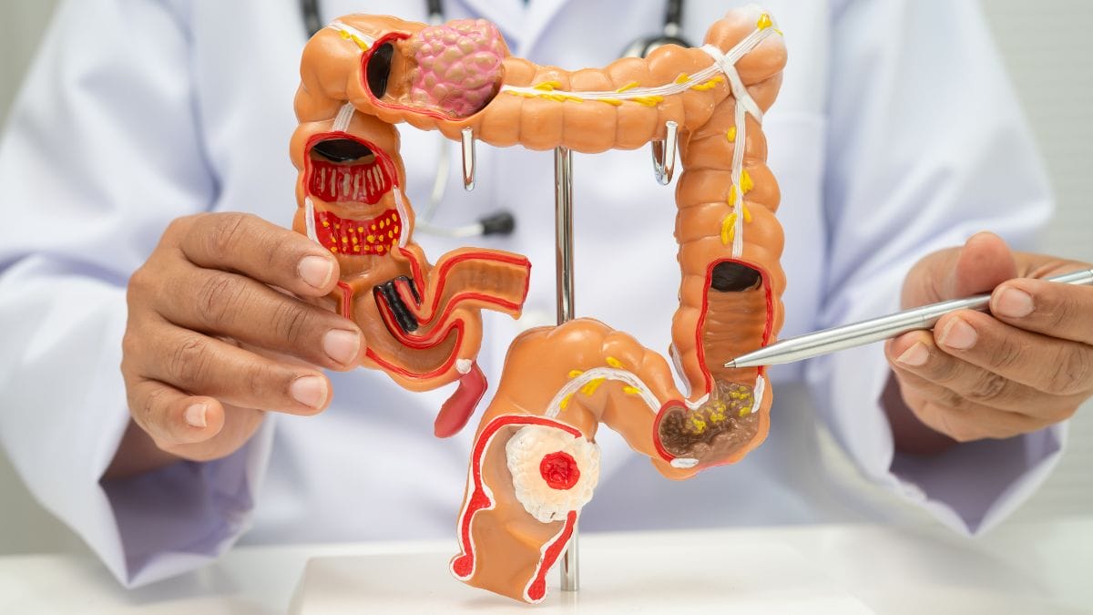 Cancer de intestino