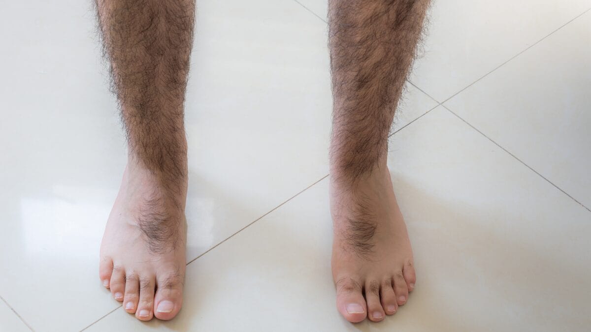 Dieta não resolve entenda o lipedema masculino e os 4 sinais de alerta no corpo