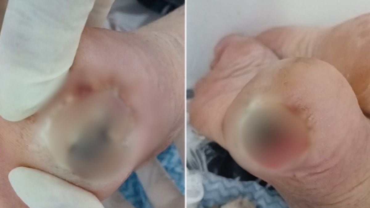 Foto do p&eacute; de um dos pacientes do lar de idosos, a imagem mostra um machucado nos p&eacute;s