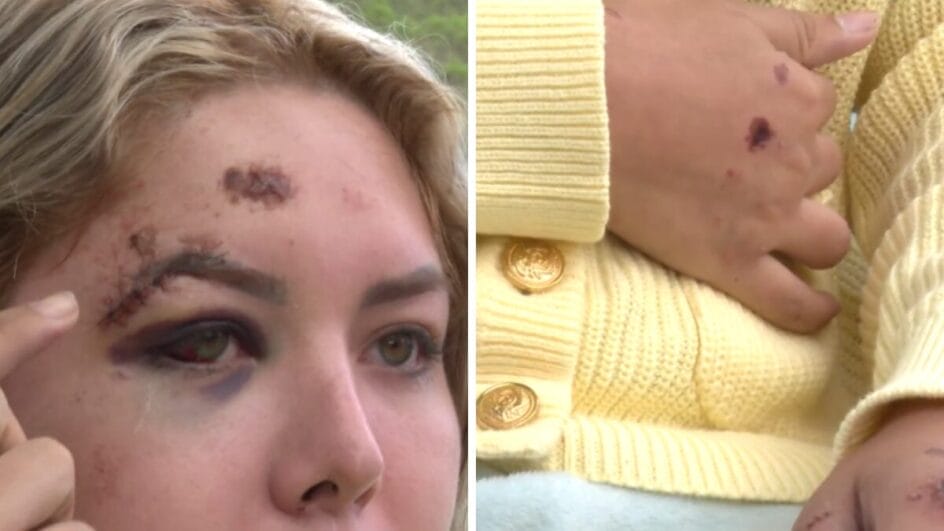 Jovem teve ferimentos no rosto e no corpo (Foto: NSC TV, Reprodução)