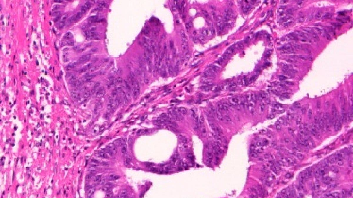 No câncer, a capacidade de adaptação das células pode virar uma vantagem para o tumor durante a metástase (Foto: Rathore, Iftikhar, Chaddad, Niazi, Karasic e Bilello / Wikimedia Commons)