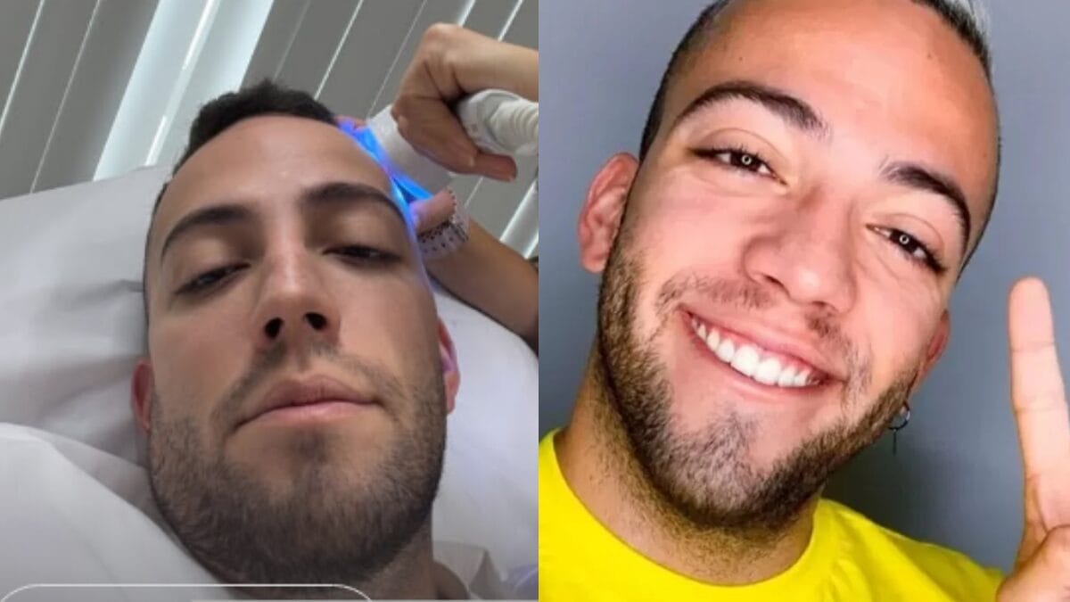 Lucas Rangel compartilha diagnóstico de alopecia após sinais de manchinhas na cabeça