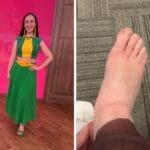 Repórter da Globo mostra pés inchados e desabafa sobre lipedema: “Mais ativo do que nunca”