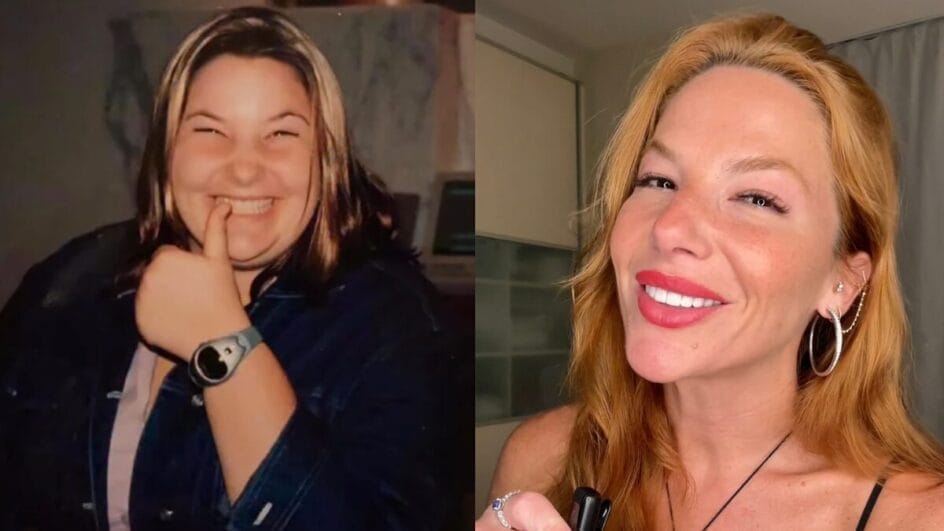 Repórter da Globo revela perda de dentes e complicações após bariátrica A cirurgia não é fácil