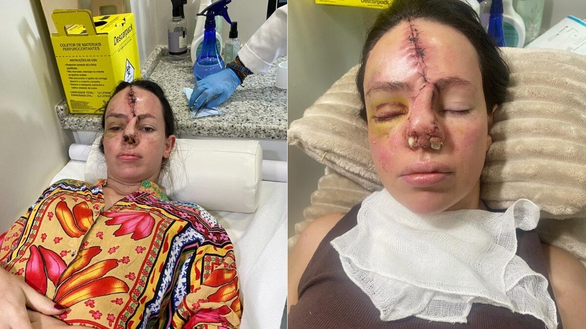 moradora de SC compartilha superação após acidente e sensibiliza a web
