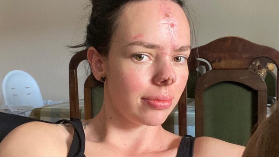 moradora de SC compartilha superação após acidente e sensibiliza a web