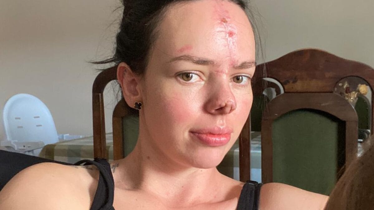 moradora de SC compartilha superação após acidente e sensibiliza a web