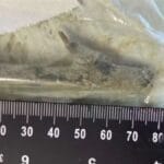 Paciente descobre pedaço de madeira de 8 cm dentro da perna após erro médico e caso vai parar na Justiça em SC