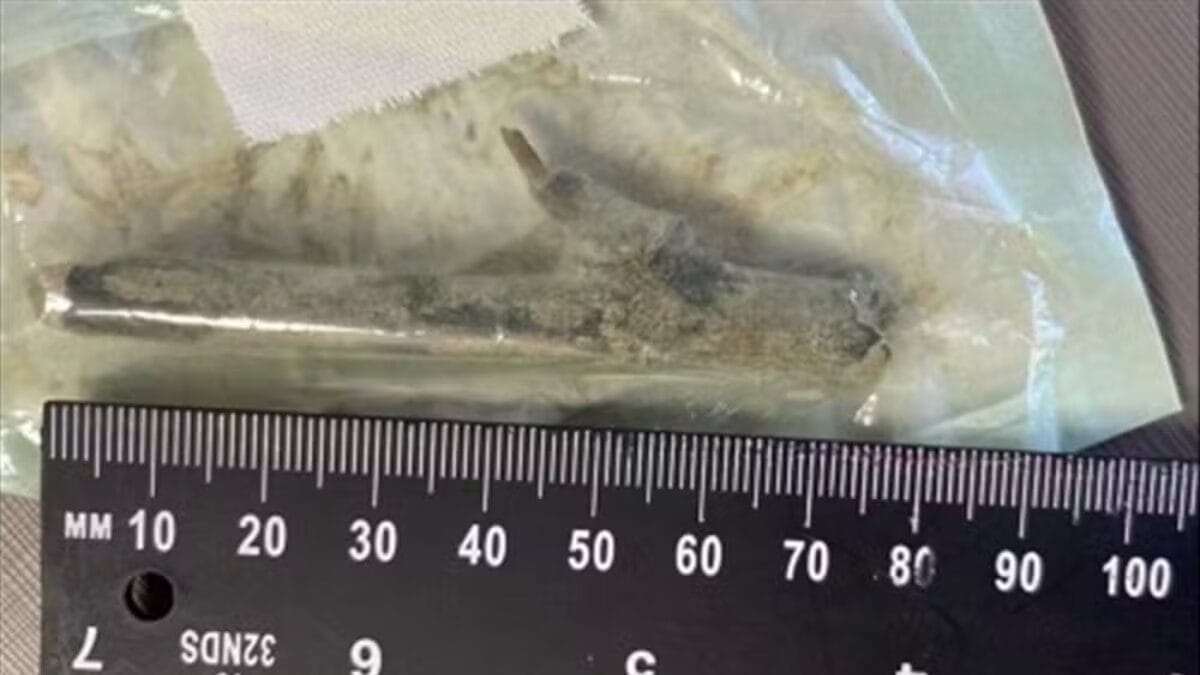 Paciente descobre pedaço de madeira de 8 cm dentro da perna após erro médico e caso vai parar na Justiça em SC