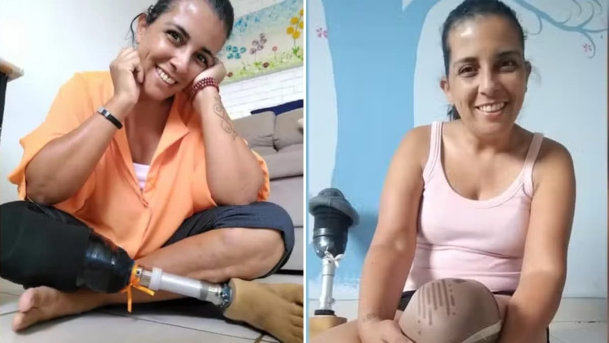 Professora atropelada por trem e picada por cobra ao mesmo tempo busca prótese após 20 anos de dor e cirurgias