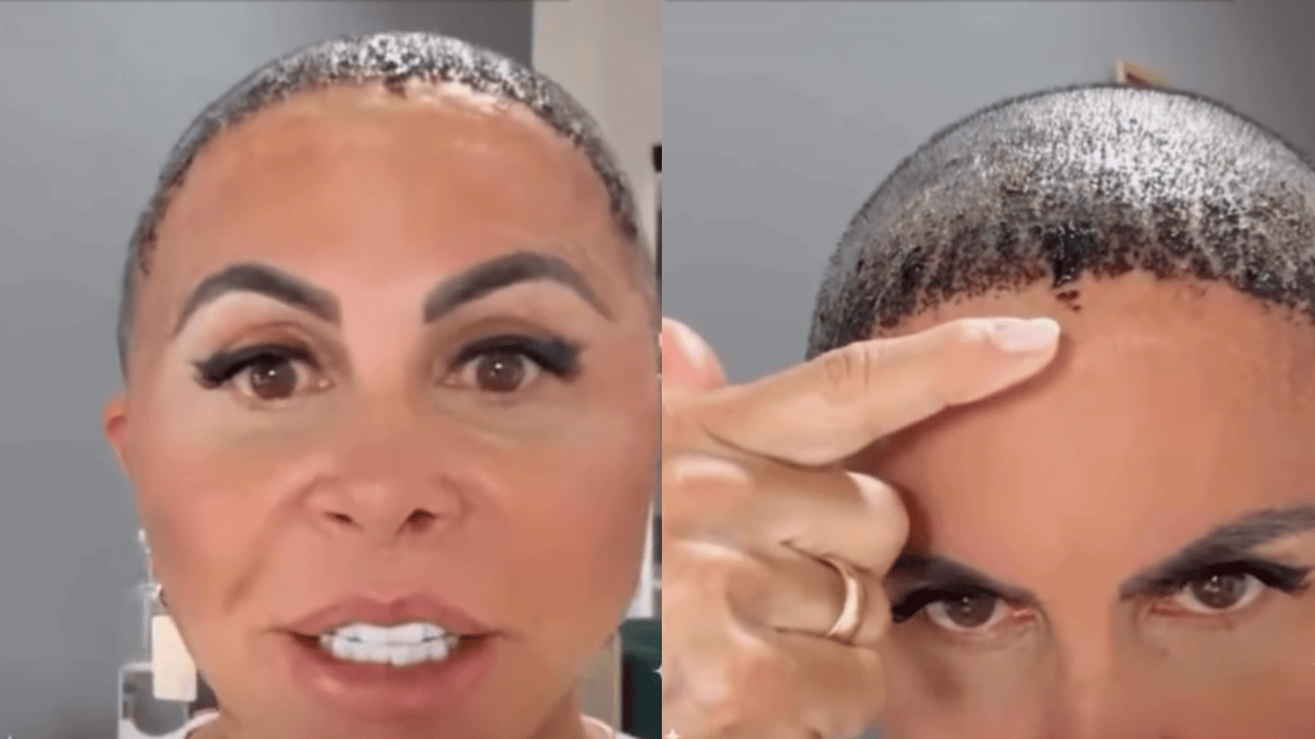 Gretchen aparece irreconhecível durante recuperação de transplante capilar: “Tudo no meu rosto vai chamar atenção”