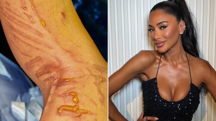 Nicole Scherzinger sofre queimaduras com água fervente uma hora antes de show: “Tem que continuar”