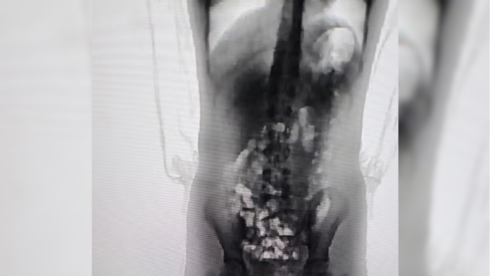 Menina de 13 anos é levada ao hospital após tentar entrar com “supermaconha” dentro do corpo em presídio de SC