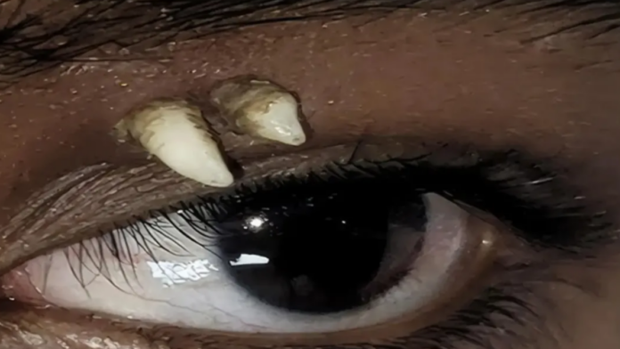 Adolescente tem dente crescendo dentro da órbita ocular em caso considerado inédito