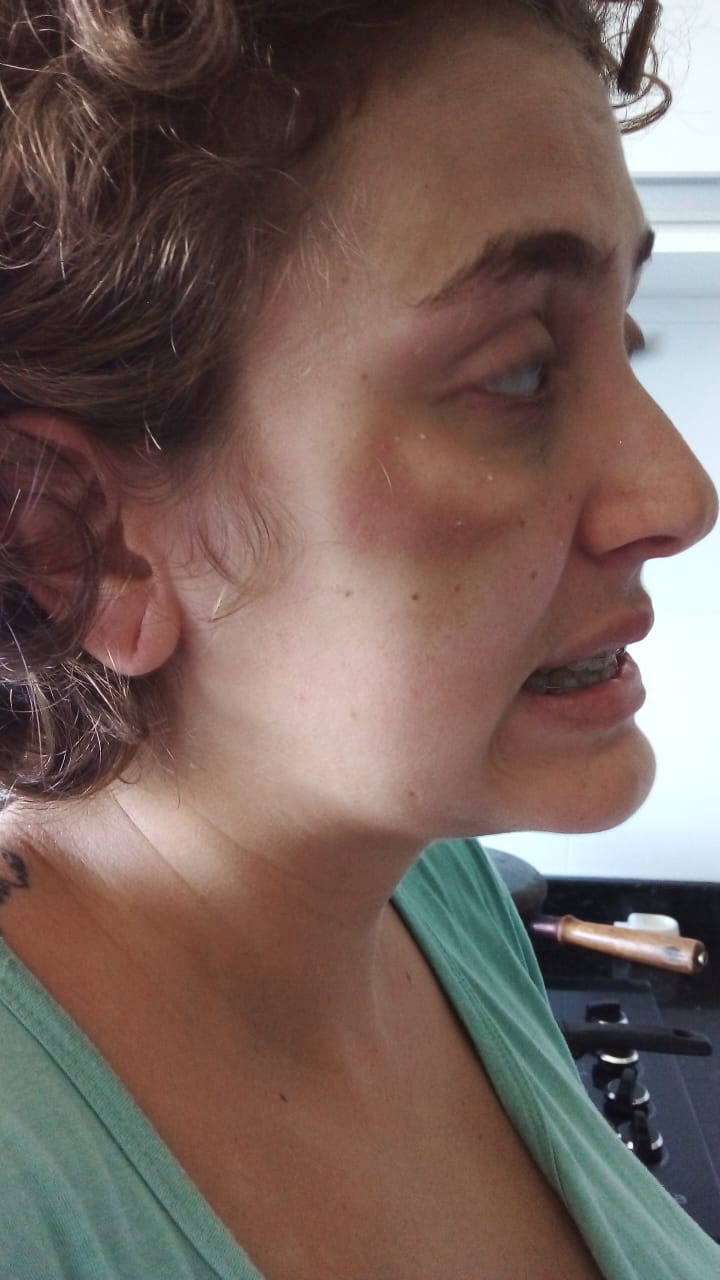 A agressividade faz parte da síndrome. Na foto, Isabela registra os hematomas causados em momentos de crise - FOTO: Arquivo pessoal saúde